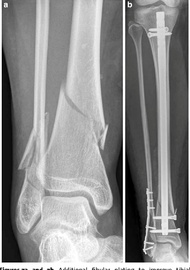 Showcase Image for The Role of Fibula Fixation in Preventing Malalignment in Distal Third Tibia Fractures Treated with Intramedullary Nailing