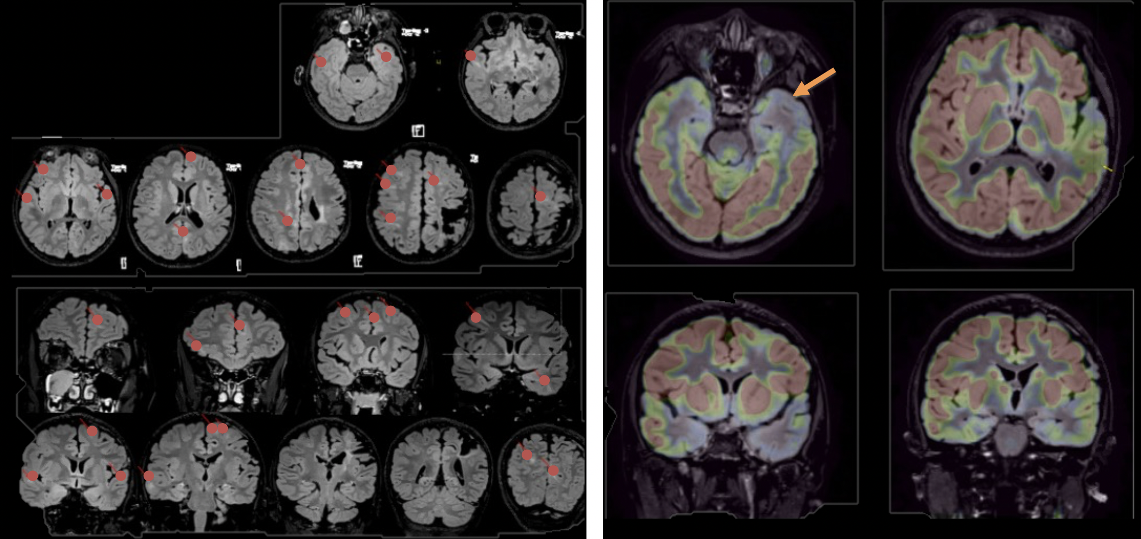 Showcase Image for The Path to Epilepsy Surgery for a Pediatric Patient with Tuberous Sclerosis Complex and Autism Spectrum Disorder: A Case Study