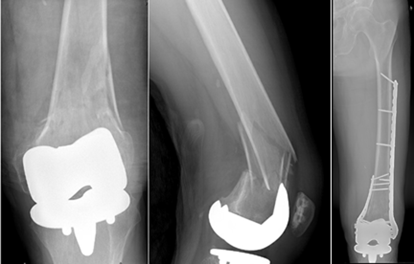 Showcase Image for Dual Plating of Periprosthetic Distal Femur Fractures Leads to Near Anatomic Coronal Plane