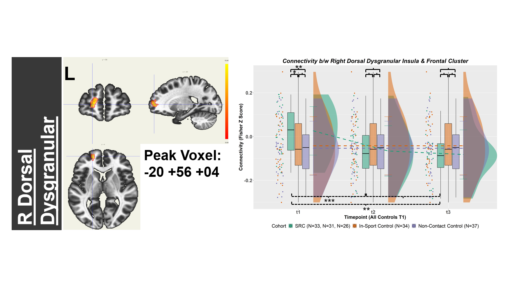 Showcase Image for Resting-State Connectivity Between the Insula and the Prefrontal Cortex Is Sensitive to Injury and Recovery after Sport-Related Concussion