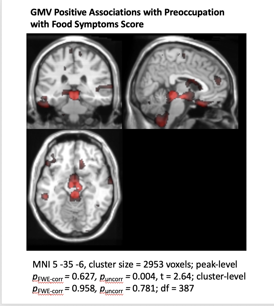 Showcase Image for Specificity of Gray Matter Volumes Predicting Dimensions of Eating Pathologies