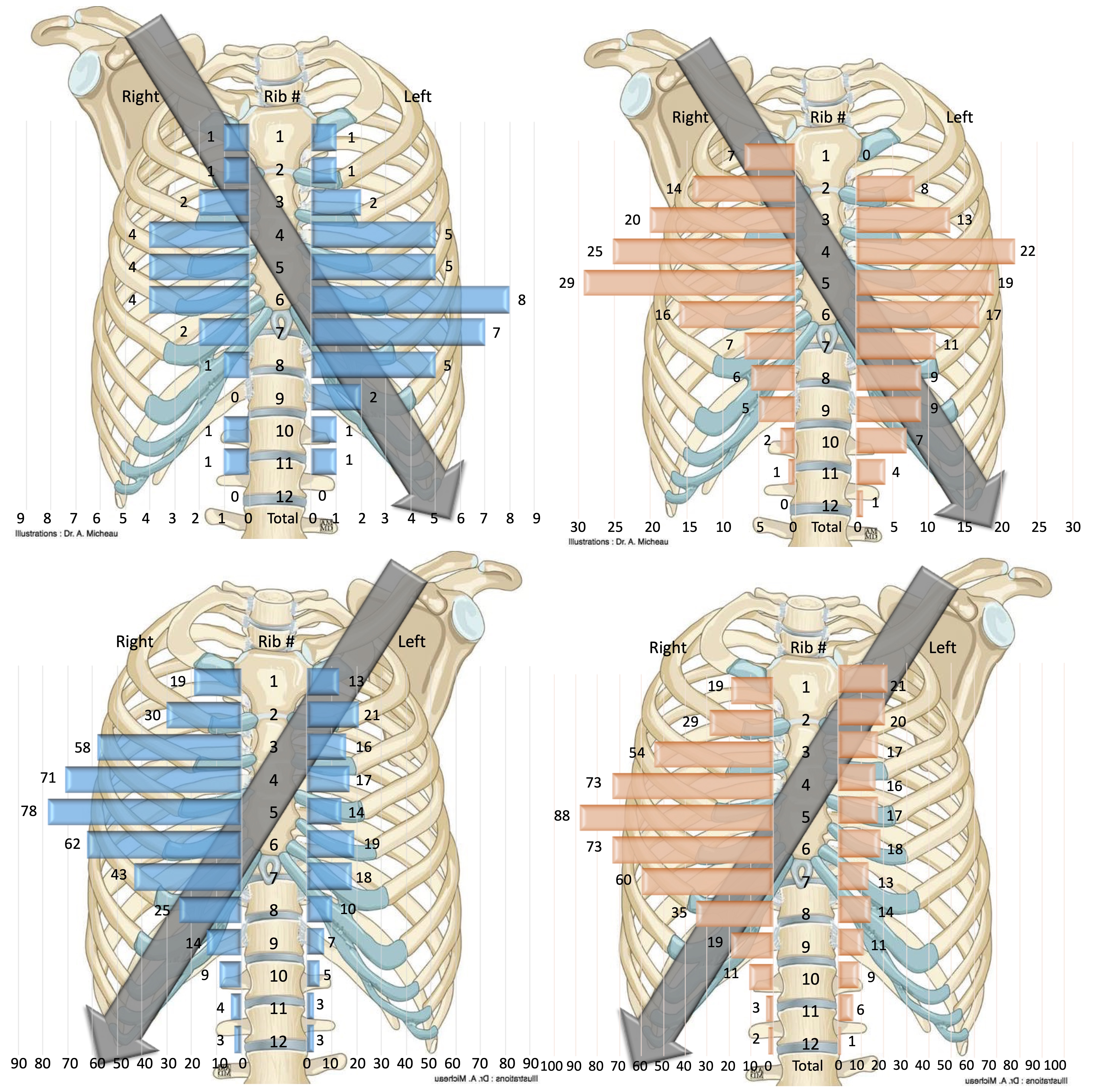 Showcase Image for Sex Differences in Thoracic Injury Patterns and Mechanisms in Seriously Injured Motor Vehicle Crash Occupants 