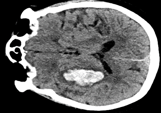 Showcase Image for Scoping Review of Literature on B-Mode Cranial Ultrasonography to Detect Intracranial Hemorrhage